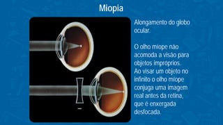 Miopia
Alongamento do globo
ocular.
O olho míope não
acomoda a visão para
objetos impróprios.
Ao visar um objeto no
infinito o olho míope
conjuga uma imagem
real antes da retina,
que é enxergada
desfocada.
 