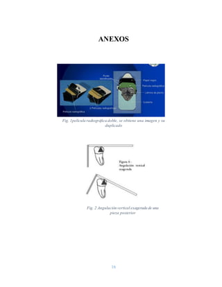 16
ANEXOS
Fig. 1película radiográfica doble, se obtiene una imagen y su
duplicado
Fig. 2 Angulación vertical exagerada de una
pieza posterior
 