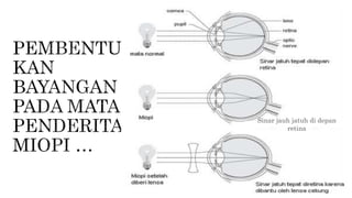 Sinar jauh jatuh di depan
retina
 