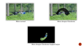 Mata normal Mata dengan Glaukoma
Mata dengan Glaukoma tingkat lanjut
 