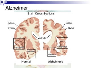Alzheimer 