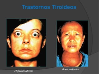 Trastornos Tiroideos
Hipertiroidismo
Bocio endémico
 