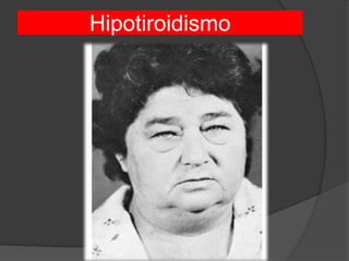 Hipotiroidismo
 