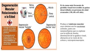 Es la causa más frecuente de
pérdida visual irreversible en países
desarrollados en personas de edad
avanzada (>50, 60 o 65 año).
Produce el síndrome macular
cuyo síntoma son los escotomas
centrales, junto con
metamorfopsias que se exploran
con la rejilla de Amsler,
disminución de la agudeza visual,
alteración en la visión de los
colores y micropsia/macropsia.
 