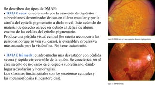 Se describen dos tipos de DMAE:
• DMAE seca: caracterizada por la aparición de depósitos
subretinianos denominados drusas en el área macular y por la
atrofia del epitelio pigmentario a dicho nivel. Este acúmulo de
material de desecho parece ser debido al déficit de alguna
enzima de las células del epitelio pigmentario.
Produce una pérdida visual central (les cuesta reconocer a las
personas porque no ven sus caras), irreversible y progresiva
más acusada para la visión fina. No tiene tratamiento.
• DMAE húmeda: cuadro mucho más devastador con pérdida
severa y rápida e irreversible de la visión. Se caracteriza por el
crecimiento de neovasos en el espacio subretiniano, dando
lugar a exudación y hemorragias.
Los síntomas fundamentales son los escotomas centrales y
las metamorfopsias (líneas torcidas).
 