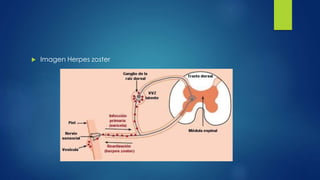  Imagen Herpes zoster
 