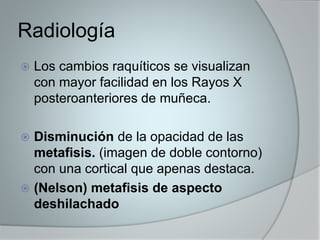 Radiología 
 Los cambios raquíticos se visualizan 
con mayor facilidad en los Rayos X 
posteroanteriores de muñeca. 
 Disminución de la opacidad de las 
metafisis. (imagen de doble contorno) 
con una cortical que apenas destaca. 
 (Nelson) metafisis de aspecto 
deshilachado 
 