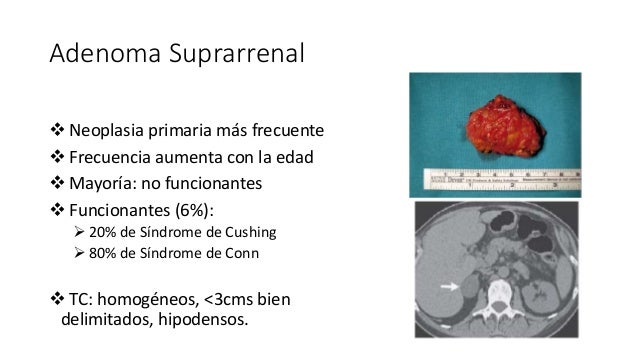 Fisiología y tumores suprarrenales
