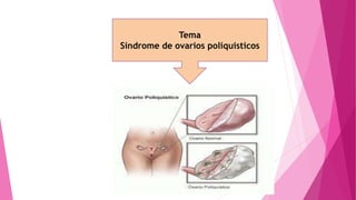 Tema
Síndrome de ovarios poliquisticos
 