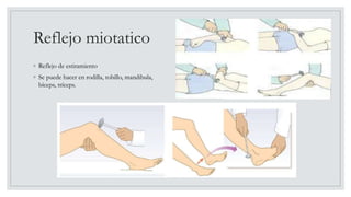 Reflejo miotatico
◦ Reflejo de estiramiento
◦ Se puede hacer en rodilla, tobillo, mandibula,
bíceps, tríceps.
 