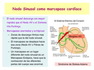 Nodo Sinusal como marcapaso cardíaco El nodo sinusal descarga con mayor rapidez que el Nodo AV o el Sistema His-Purkinje. Marcapasos anormales y ectópicos: Zonas de descarga rítmica mas rápida que la del nodo sinusal. El marcapaso se desplaza hacia esa zona (Nodo AV o Fibras de Purkinje). Un marcapaso en un lugar diferente del nodo sinusal es un Marcapaso Ectópico, hace que la contracción de las diferentes partes del cuerpo sea anormal. Sindrome de Stokes-Adams Bloqueo AV 
