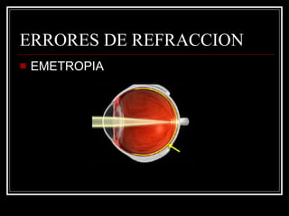 ERRORES DE REFRACCION EMETROPIA 