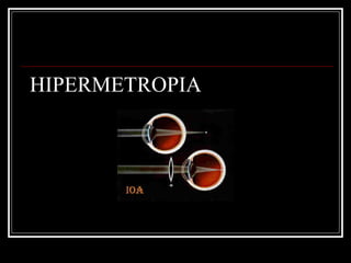 HIPERMETROPIA 