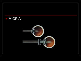 MIOPIA 