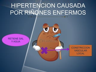 HIPERTENCION CAUSADA
POR RIÑONES ENFERMOS
CONSTRICCION
VASCULAR
LOCAL
RETIENE SAL
Y AGUA
 