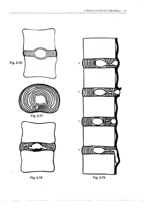 3. TROKCO E COLUNA VERTEBRAL   125




Fig.3-76              A




                      B




           Fig.3-77
                      c




                      D




           Fig.3-78              Fig.3-79
 