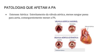 PATOLOGIAS QUE AFETAM A PA
● Estenose Aórtica: Estreitamento da válvula aórtica, menos sangue passa
para aorta, consequentemente menor a PA.
 