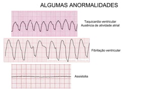 ALGUMAS ANORMALIDADES
Taquicardia ventricular
Ausência de atividade atrial
Fibrilação ventricular
Assistolia
 