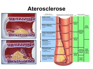 Aterosclerose
 