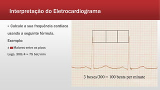 Interpretação do Eletrocardiograma
 Calcule a sua frequência cardíaca
usando a seguinte fórmula.
Exemplo:
4 Maiores entre os picos
Logo, 300/4 = 75 bat/min
 