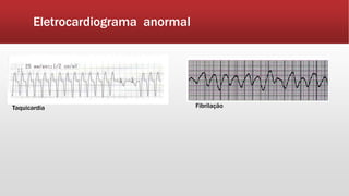 Eletrocardiograma anormal
Taquicardia Fibrilação
 