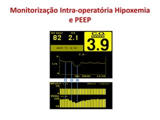 Monitorização Intra-operatória Hipoxemia
e PEEP
 