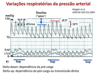 Variações respiratórias da pressão arterial
Magder et al
AJRCCM 169:151;2004
Delta down: dependência da pré-carga
Delta up: dependência da pós-carga ou transmissão direta
 