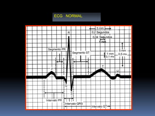 ECG NORMAL
 