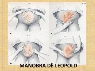 MANOBRA DE LEOPOLD
 