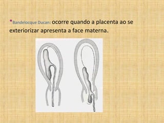 *Bandelocque Ducan: ocorre quando a placenta ao se
exteriorizar apresenta a face materna.
 
