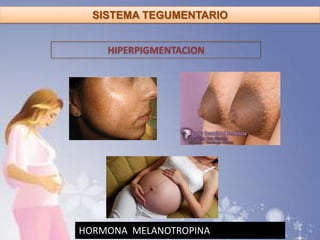 SISTEMA TEGUMENTARIO
HIPERPIGMENTACION
HORMONA MELANOTROPINA
 