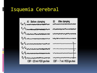 Isquemia Cerebral