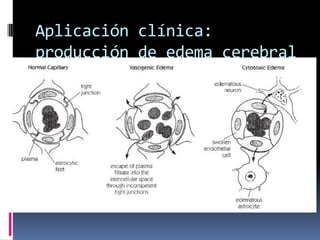 Aplicación clínica: producción de edema cerebral