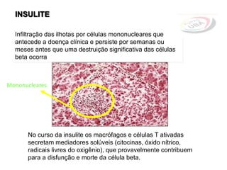 Infiltração das ilhotas por células mononucleares que
antecede a doença clínica e persiste por semanas ou
meses antes que uma destruição significativa das células
beta ocorra
INSULITE
No curso da insulite os macrófagos e células T ativadas
secretam mediadores solúveis (citocinas, óxido nítrico,
radicais livres do oxigênio), que provavelmente contribuem
para a disfunção e morte da célula beta.
Mononucleares
 