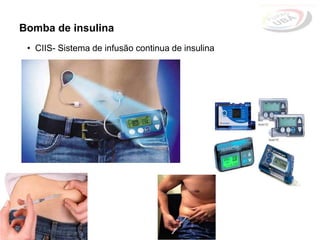 • CIIS- Sistema de infusão continua de insulina
Bomba de insulina
 