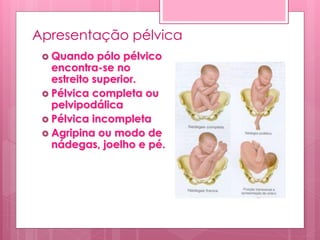 Apresentação pélvica
 Quando pólo pélvico
encontra-se no
estreito superior.
 Pélvica completa ou
pelvipodálica
 Pélvica incompleta
 Agripina ou modo de
nádegas, joelho e pé.
 