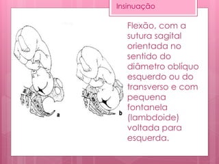 Flexão, com a
sutura sagital
orientada no
sentido do
diâmetro oblíquo
esquerdo ou do
transverso e com
pequena
fontanela
(lambdoide)
voltada para
esquerda.
Insinuação
 