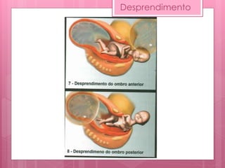 Desprendimento
 
