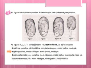 Fisiologia e mecanismo do trabalho de parto