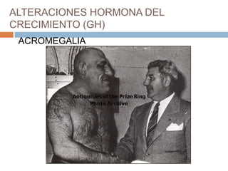 ALTERACIONES HORMONA DEL
CRECIMIENTO (GH)
 ACROMEGALIA
 
