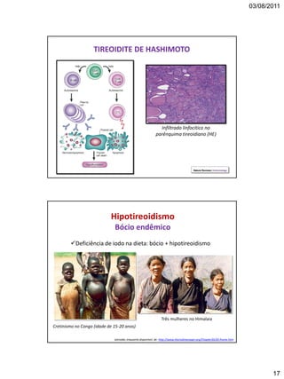 03/08/2011
17
TIREOIDITE DE HASHIMOTO
Infiltrado linfocítico no
parênquima tireoidiano (HE)
Cretinismo no Congo (idade de 15-20 anos)
extraído, enquanto disponível, de: http://www.thyroidmanager.org/Chapter20/20-frame.htm
Hipotireoidismo
Bócio endêmico
Deficiência de iodo na dieta: bócio + hipotireoidismo
Três mulheres no Himalaia
 