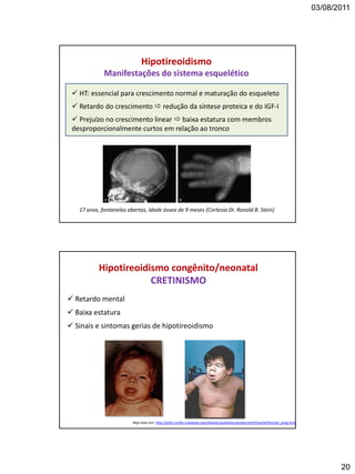 03/08/2011
20
 HT: essencial para crescimento normal e maturação do esqueleto
 Retardo do crescimento  redução da síntese proteica e do IGF-I
 Prejuízo no crescimento linear  baixa estatura com membros
desproporcionalmente curtos em relação ao tronco
Hipotireoidismo
Manifestações do sistema esquelético
17 anos, fontanelas abertas, idade óssea de 9 meses (Cortesia Dr. Ronald B. Stein)
 Retardo mental
 Baixa estatura
 Sinais e sintomas gerias de hipotireoidismo
Hipotireoidismo congênito/neonatal
CRETINISMO
Veja mais em: http://arbl.cvmbs.colostate.edu/hbooks/pathphys/endocrine/thyroid/thyroid_preg.html
 