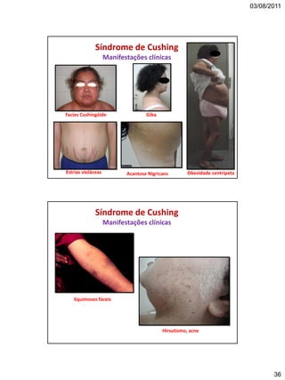 03/08/2011
36
Facies Cushingóide
Síndrome de Cushing
Manifestações clínicas
Giba
Acantose NigricansEstrias violáceas Obesidade centrípeta
Síndrome de Cushing
Manifestações clínicas
Equimoses fáceis
Hirsutismo, acne
 
