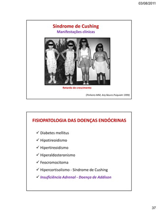 03/08/2011
37
Síndrome de Cushing
Manifestações clínicas
(Pinheiro MM, Arq Neuro-Psiquiatr 1999)
Retardo de crescimento
FISIOPATOLOGIA DAS DOENÇAS ENDÓCRINAS
 Diabetes mellitus
 Hipotireoidismo
 Hipertireoidismo
 Hiperaldosteronismo
 Feocromocitoma
 Hipercortisolismo - Síndrome de Cushing
 Insuficiência Adrenal - Doença de Addison
 
