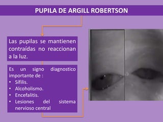 PUPILA DE ARGILL ROBERTSON
Las pupilas se mantienen
contraídas no reaccionan
a la luz.
Es un signo diagnostico
importante de :
• Sífilis.
• Alcoholismo.
• Encefalitis.
• Lesiones del sistema
nervioso central
 