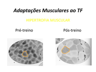 Adaptações Musculares ao TF
HIPERTROFIA MUSCULAR
Pré-treino Pós-treino
 