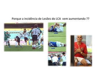 Porque a incidência de Lesões do LCA vem aumentando ??
 