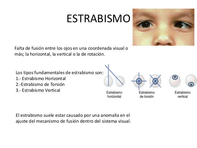 Resultado de imagen para fusion de las imagenes en ambos ojos