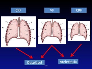 VF CRFCRF
Desejável Atelectasia
PVM
 