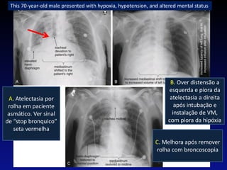 PVM
A. Atelectasia por
rolha em paciente
asmático. Ver sinal
de “stop bronquico”
seta vermelha
B. Over distensão a
esquerda e piora da
atelectasia a direita
após intubação e
instalação de VM,
com piora da hipóxia
C. Melhora após remover
rolha com broncoscopia
This 70-year-old male presented with hypoxia, hypotension, and altered mental status
 